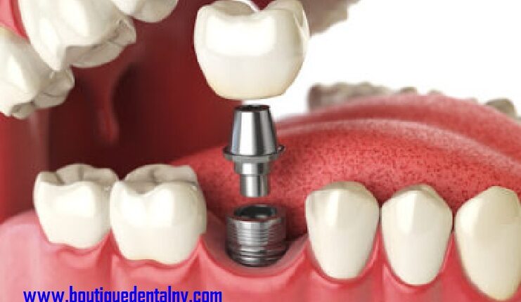 Dental Implants Glendale - Ideal Place To Call