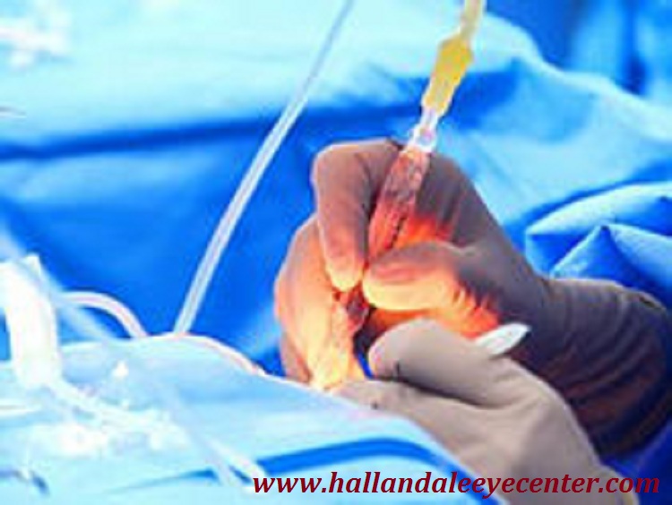 How beneficial laser cataract surgery Sunny Isles is?